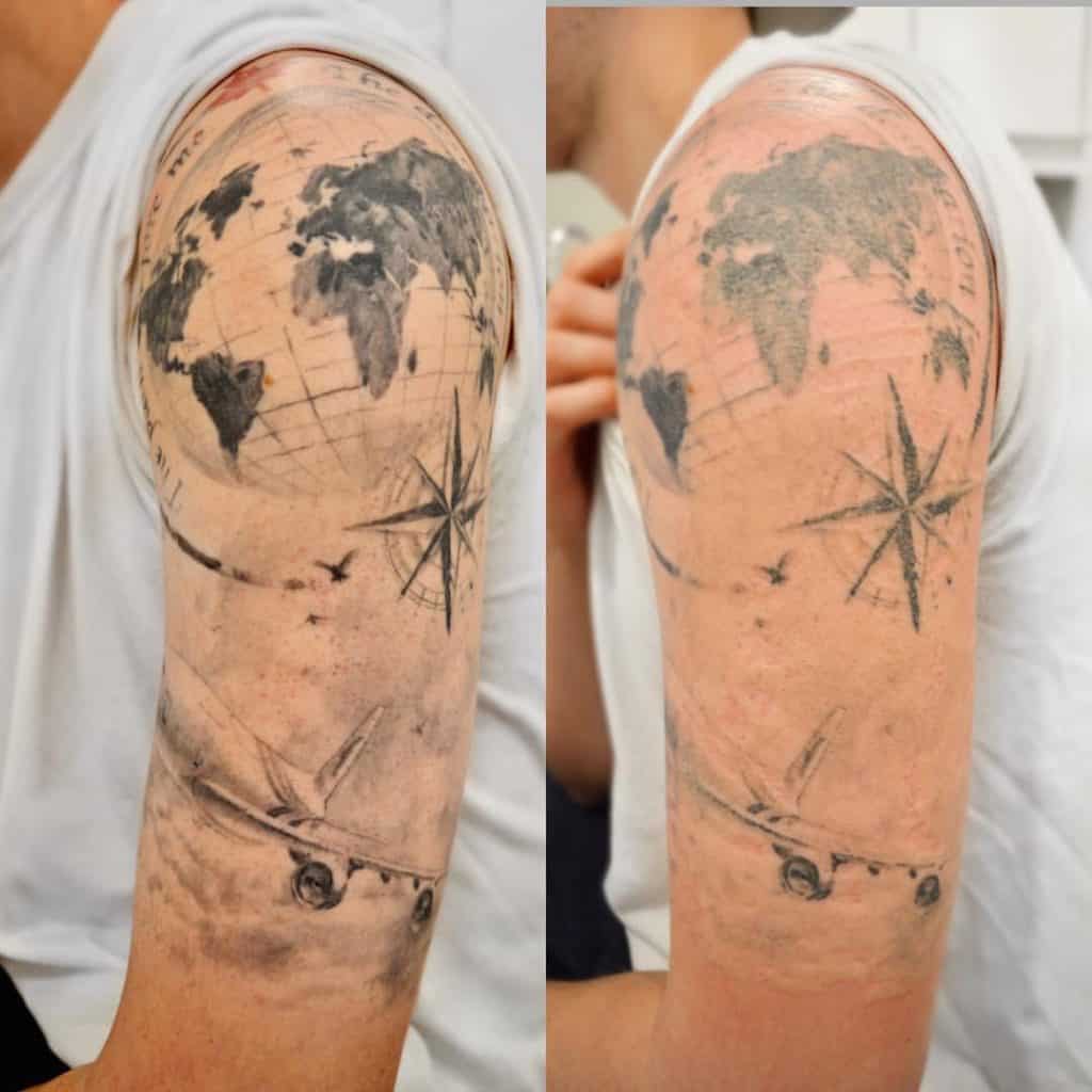 Tattoo Removal in Progress