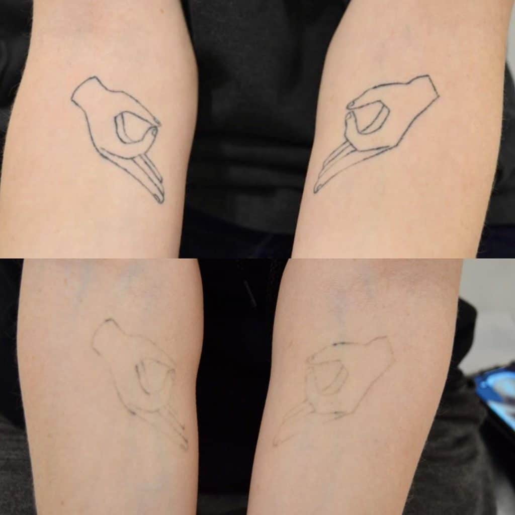 Laser Tattoo Removal Session
