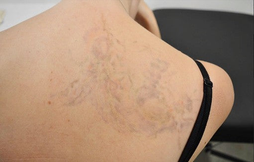 Scars After Laser Tattoo Removal